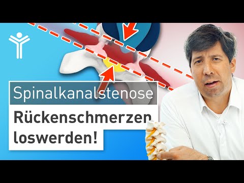 Rückenschmerzen durch Spinalkanalstenose richtig behandeln | Wann operieren?