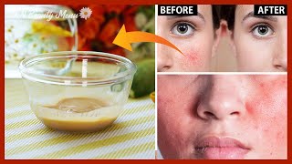 ✨Get rid of Red Irritated skin✨Menu 15: How to quickly reduce Redness, Rosacea, Itchy on the face.