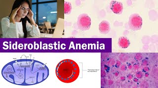 Sideroblastic Anemia ( Clear & Complete Explain )