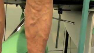 CHIVA di varici ad origine da una perforante alla coscia