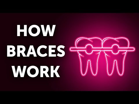 How Braces Work (And Why So Slow)