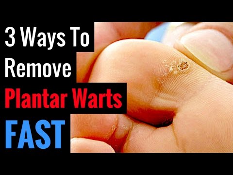 how to prevent plantar warts from coming back