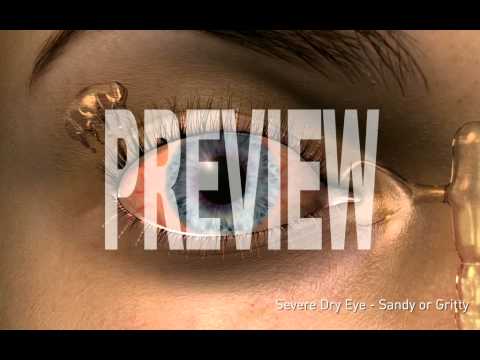 Sight Selector: Dry Eyes (607 G14)