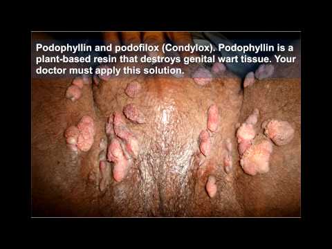 Virus del papiloma humano genotipo 52