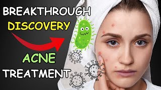 ACNE NO MORE: A NEW Game-Changing Treatment !! (RESEARCH BACKED DISCOVERY)