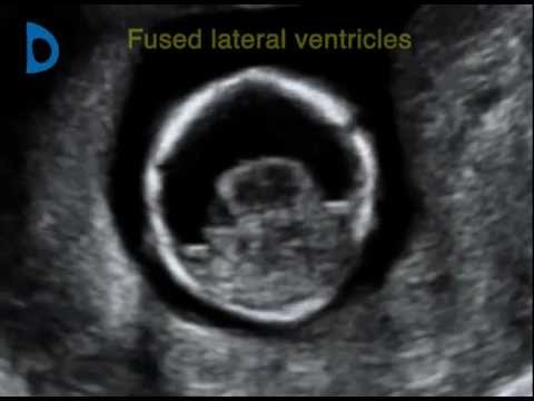 Fetal Medicine Foundation - alobar holoprosencephaly 12 weeks