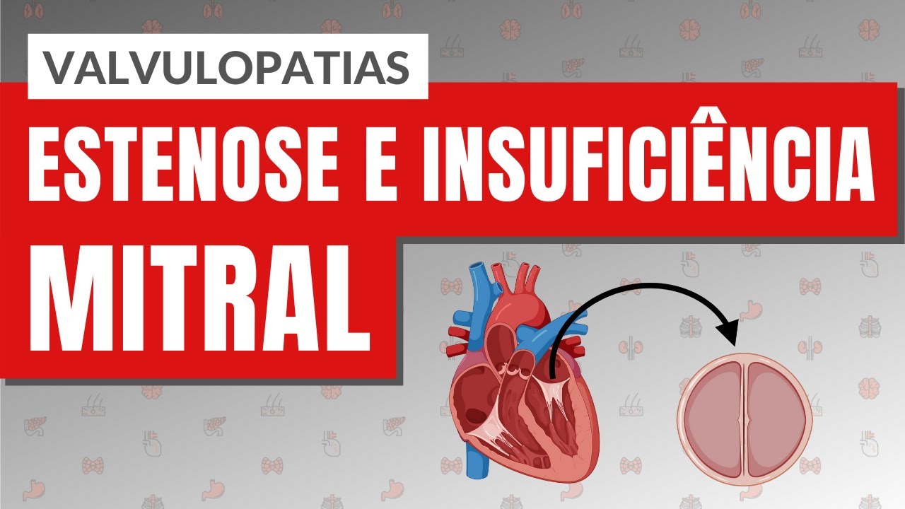 VALVULOPATIAS I PARTE 3: Estenose e Insuficiência mitral