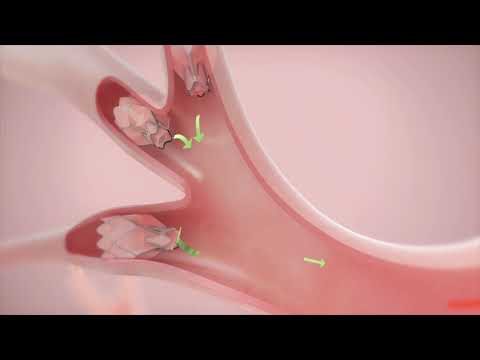 How It Works: Zephyr Valve Treatment for COPD & Emphysema