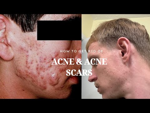 How To Get Rid Of Acne And Acne Scars (Easy & Fast)