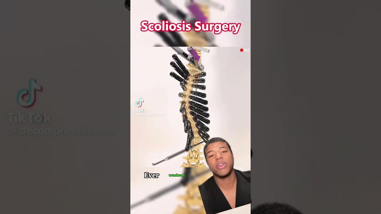 How does scoliosis surgery actually work? #Scoliosissurgery #Spinesurgery #spinesurgery