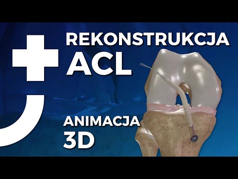 Rekonstrukcja ACL kolana - animacja 3D - Nowa Ortopedia®