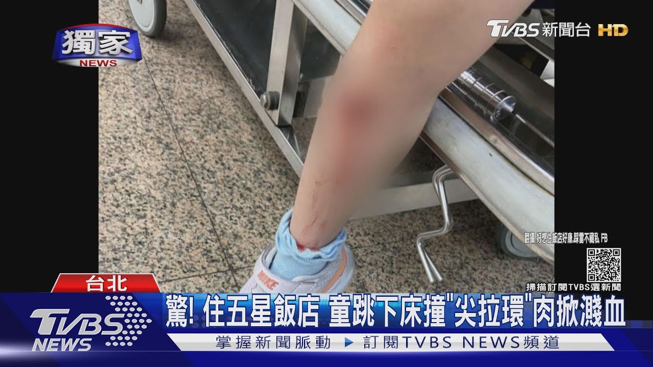 驚 !住五星飯店 童跳下床撞「尖拉環」肉掀濺血