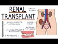 Understanding Kidney Transplants