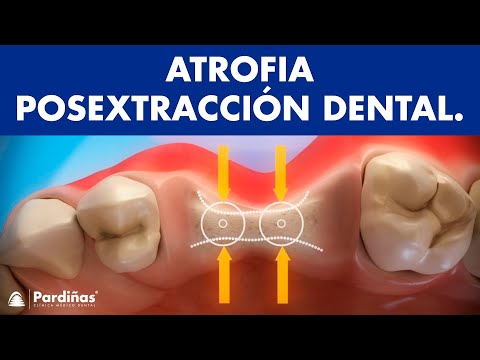 Atrofia de hueso posextracción dental ©