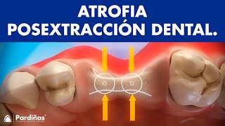 Atrofia post extracción dental © 