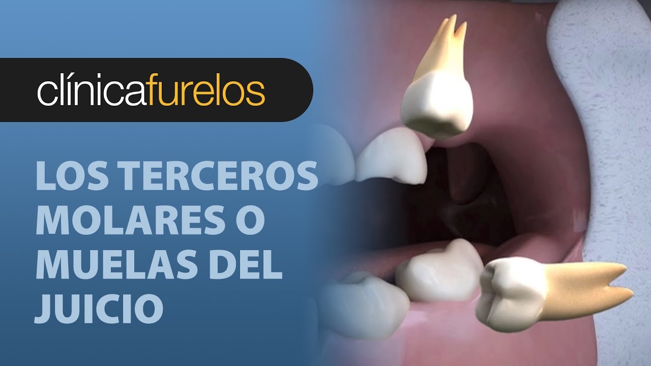 Watch Los terceros molares o muelas del juicio Now Los terceros molares o muelas del juicio