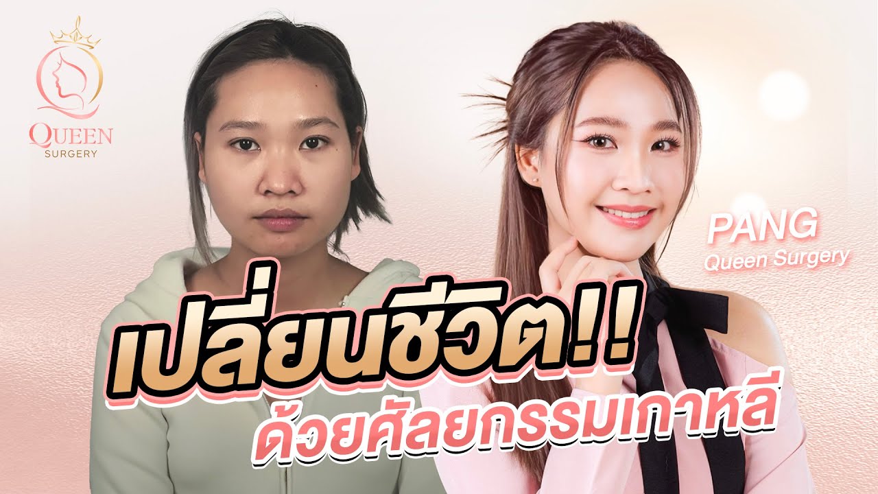 รีวิวศัลยกรรมเกาหลีเปลี่ยนชีวิต!! จากสาวหน้าบ้านๆ สู่สาวเกาหลี