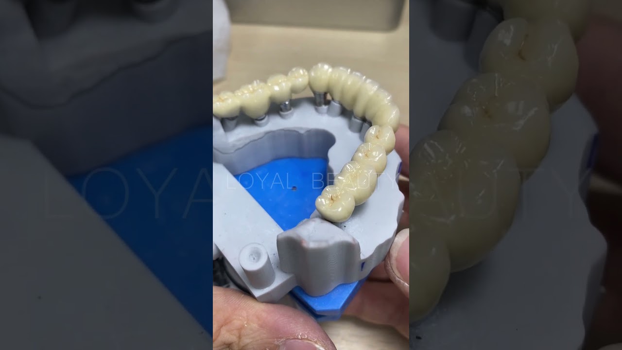 China dental lab China lab outsourcing - Cobalt chromium porcelain implant bridge - #chinadentallab