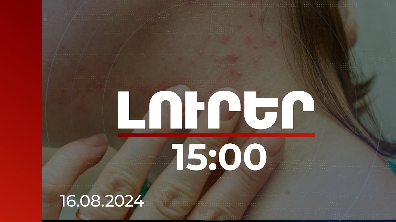 Լուրեր 15:00 | Կապիկի ծաղիկ հիվանդության՝ ՀՀ ներթափանցման ռիսկը ցածր է | 16.08.2024