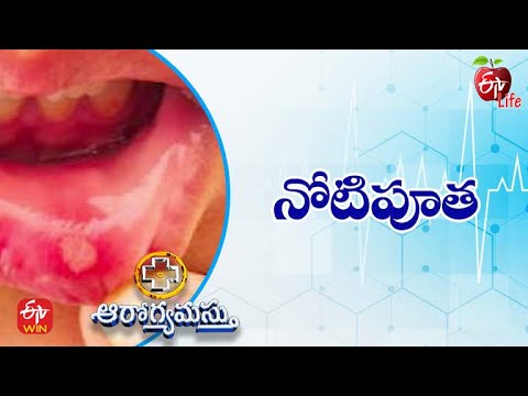 All About Canker Sores tips explain by Dentist