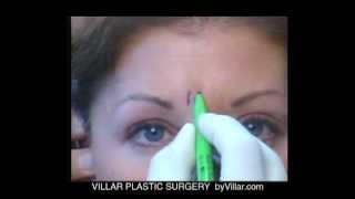 Botox ~ Secrets of the Mastercraftsmen ~ byVillar @byDrVillar #byDrVillar