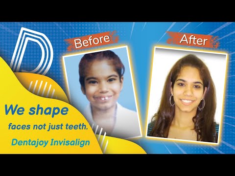 We shape faces not just teeth. Dentajoy Invisalign
