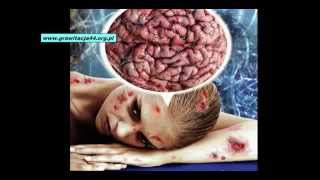 2 4 Morgellons Syndrome PL Skutki Modyfikowania Żywności GMO PROTOKÓŁ CHOROBY CHEMTRAIL x264