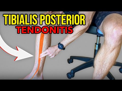 3 Exercises for Tibialis Posterior Tendonitis