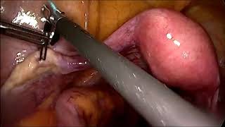 Versa Lifter Needle - Laparoscopic Hysteropexy
