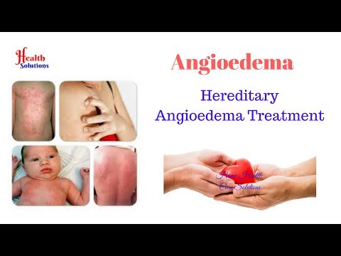Angioedema - Hereditary Angioedema Treatment Made Simple! Video