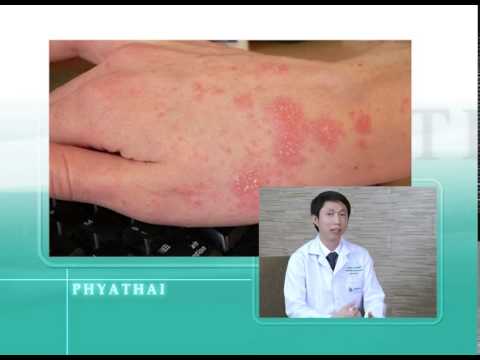 วิธีการเลือกแชมพูสำหรับโรคสะเก็ดเงิน โรคสะเก็ดเงิน medicamental วิธีการรักษา
