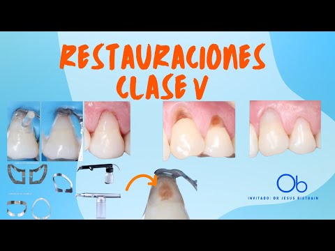Restauraciones Clase V 🦷
