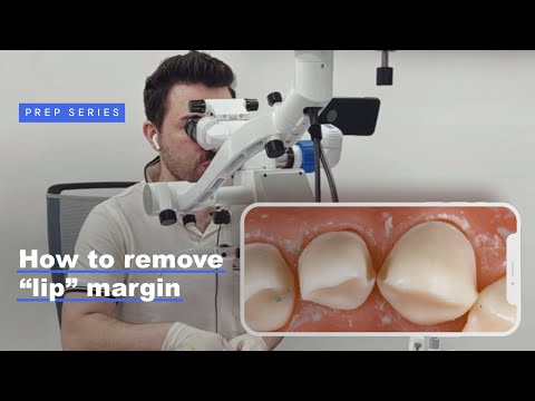 How To Remove “Lip” Margin