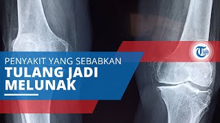 Osteomalacia, Salah Satu Jenis Penyakit Tulang Sebabkan Penderitanya Mengalami Tulang Lunak