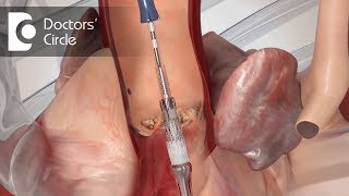 What happens during a Valvuloplasty? - Dr. Anand R Shenoy
