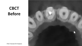 Healing of a large periapical lesion nonsurgically