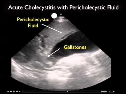 How To: Gallbladder Ultrasound Part 3 - Acute Cholecystitis Case Study Video