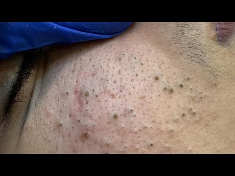 The Ultimate Facial Care Routine | Acne Treatment & Deep Cleansing