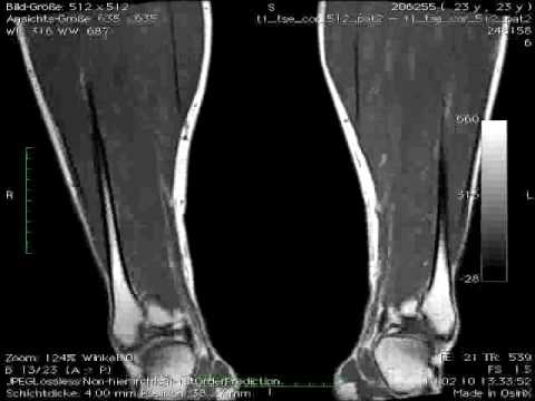 Behandlung von Rückenschmerzen zu Hause Behandlung von Osteoarthritis des Knies in Kazan