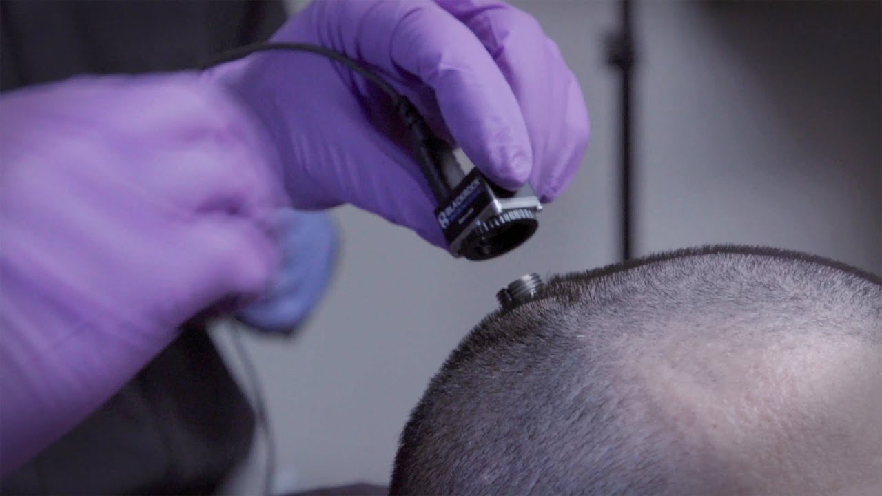 Watch brain implant help man 'speak' for the first time in 15 years
