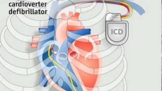 How pacemakers work | The Economist