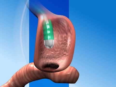 Scarless Revision Surgery after Gastric Bypass