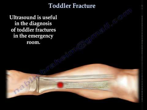 Toddler Fracture , tibial fracture in a child- Everything You Need To Know - Dr. Nabil Ebraheim