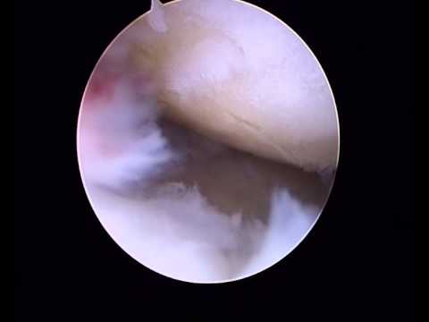 Apizartron e osteocondrosi Scarico marrone nei primi mesi del mal di schiena gravidanza