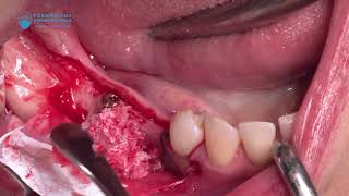 Download lagu GBR with resorbable membrane and simultaneous implant placement in the posterior mandible mp3 Download lagu GBR with resorbable membrane and simultaneous implant placement in the posterior mandible mp3