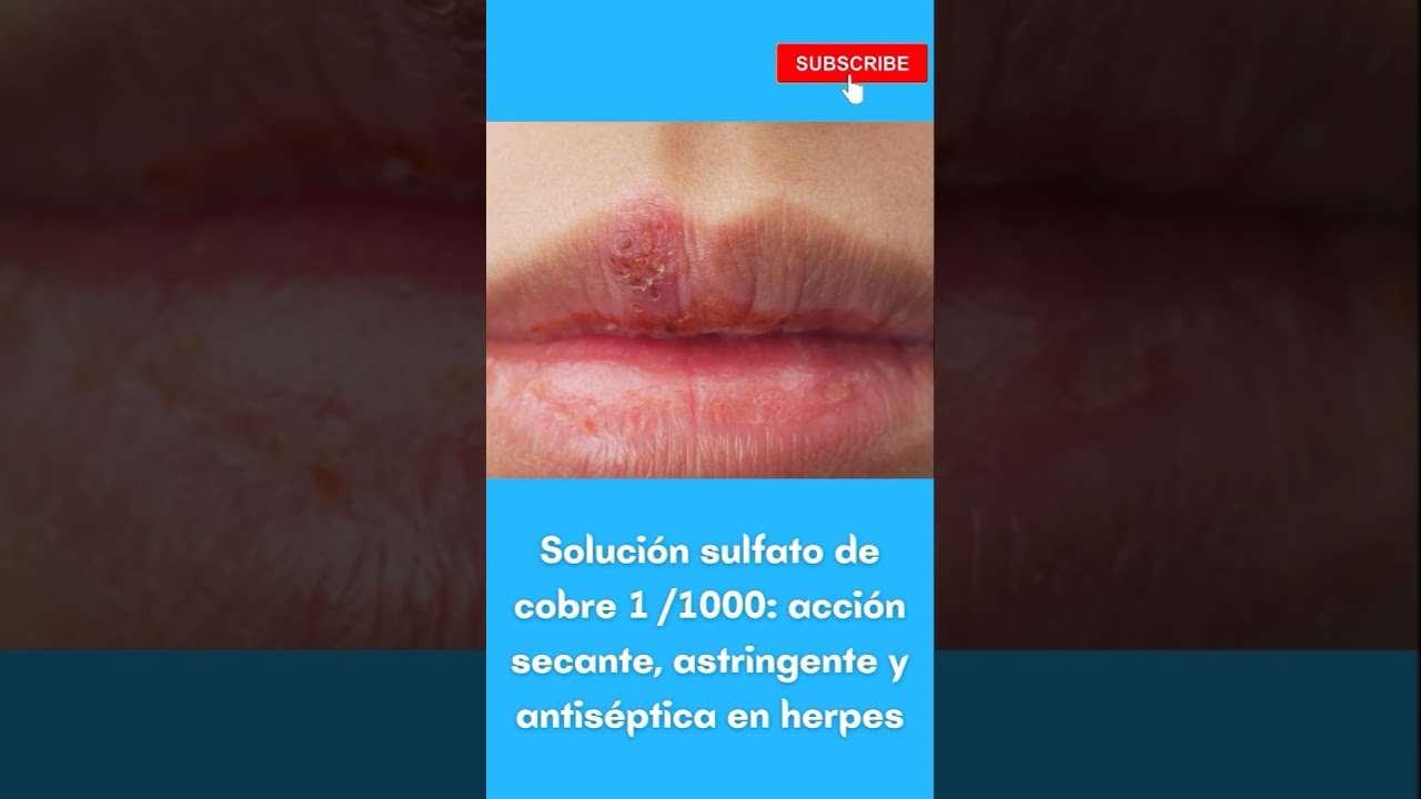 Solución de sulfato de cobre para herpes #shorts