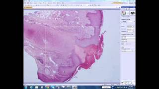 Chondrodermatitis Nodularis Helicis Chronicus