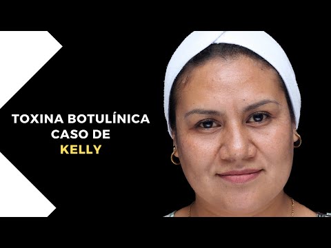 Caso de KELLY: Toxina botulínica