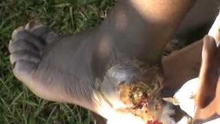 Samuel's Heal was ROTTING! Jiggers Love wounds!