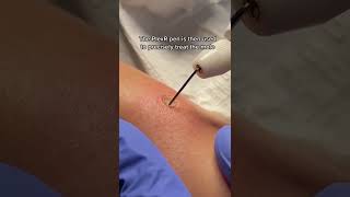 Download lagu PlexR Mole Removal at DrMediSpa mp3 Download lagu PlexR Mole Removal at DrMediSpa mp3